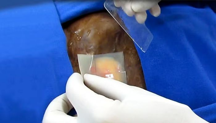 Novo implante injetável pode ser alternativa para reconstrução das mamas